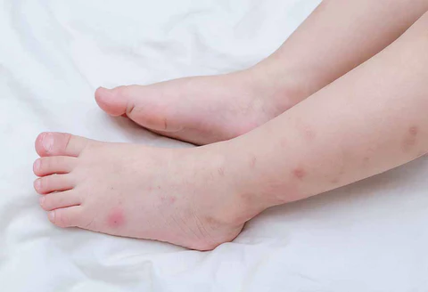 Symptoms of Baby Bed Bug Bites